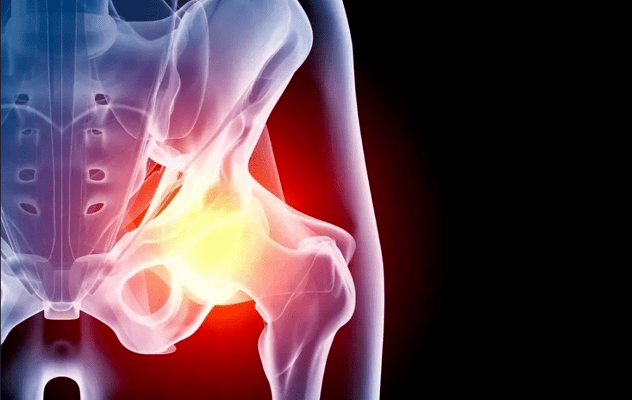 Artrosi dell'articolazione dell'anca
