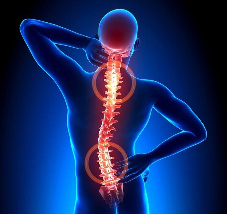 osteocondrosi della colonna vertebrale come causa di mal di schiena