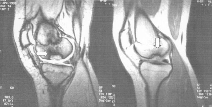 radiografia dell'osteocondrosi dissecante nell'articolazione del ginocchio