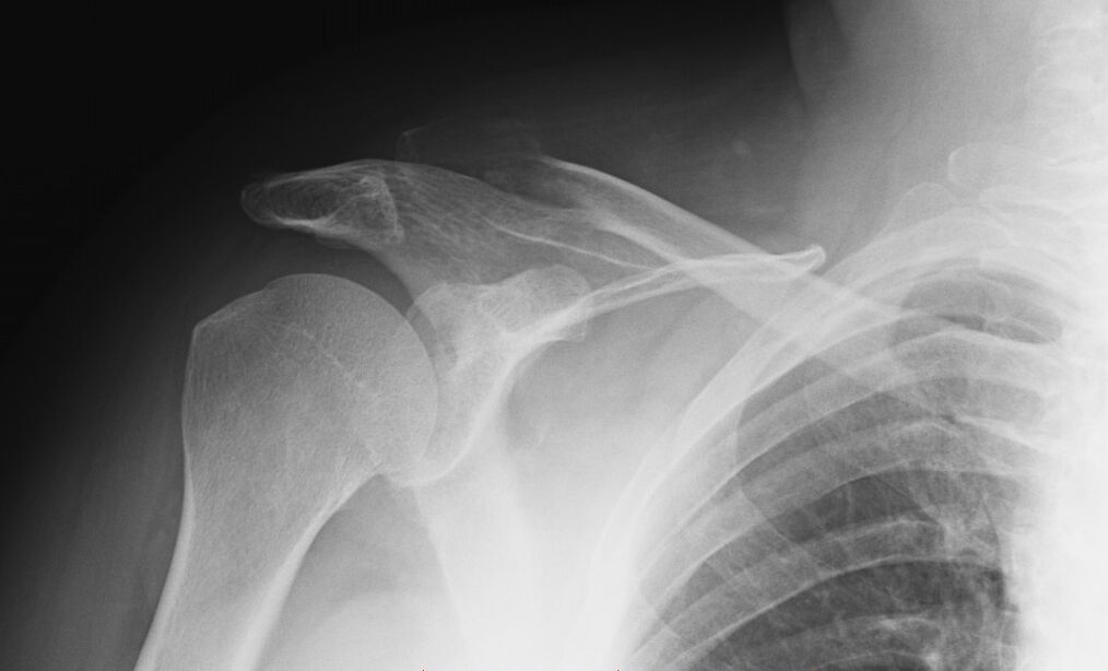 radiografia per artrosi della spalla