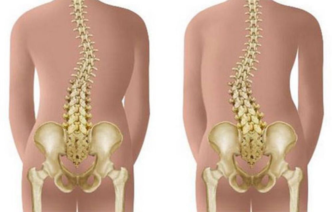 scoliosi come causa di mal di schiena nella zona delle scapole