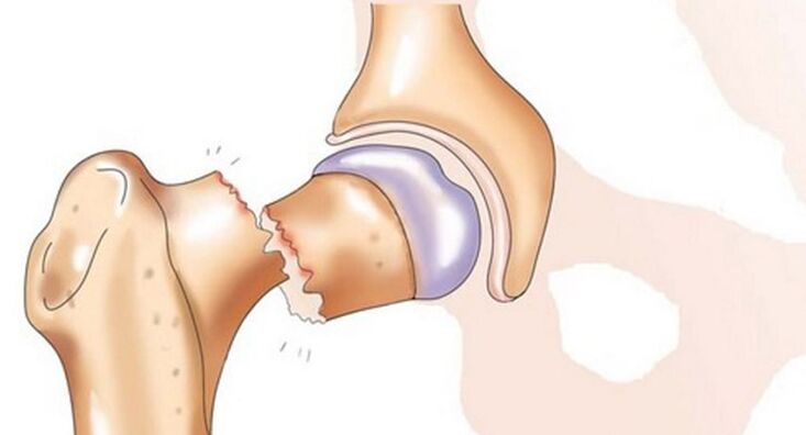 Una frattura del collo del femore è accompagnata da un forte dolore all'articolazione dell'anca